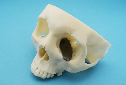 Photograph of orbital reconstruction